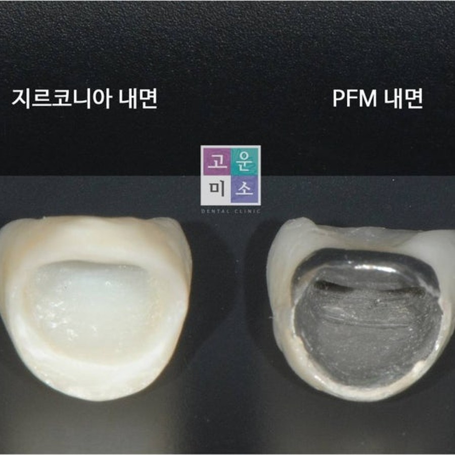 지르코니아·PFM 크라운 내면 실물 비교