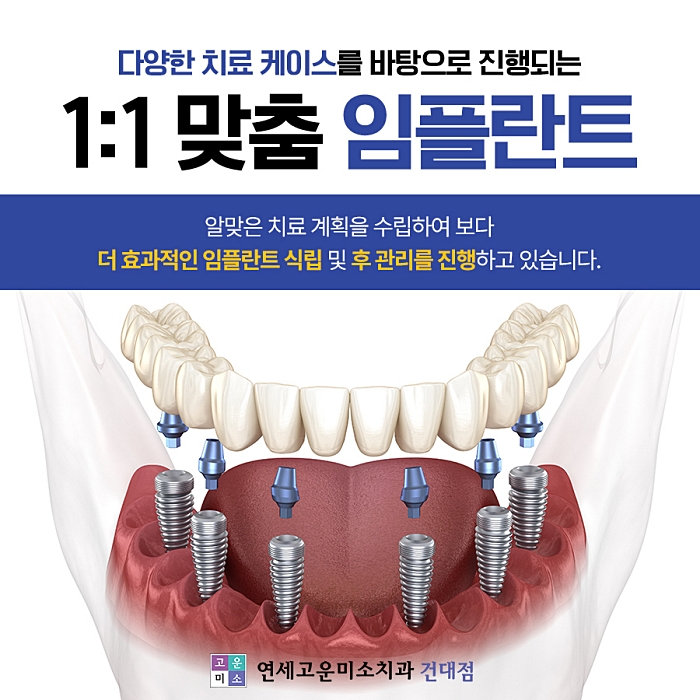 맞춤 임플란트