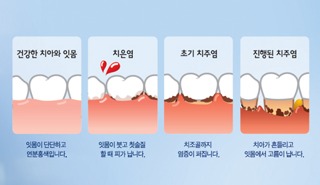 잇몸 단계 도해