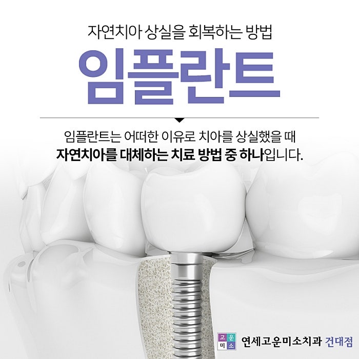 임플란트 도해